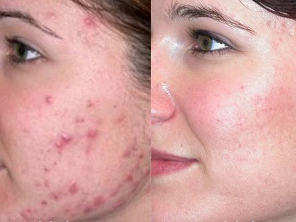 How to Get Rid Of Acne Marks fast At Home.